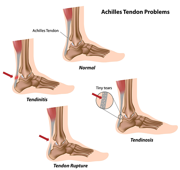 Achilles Tendonitis in Howard Beach