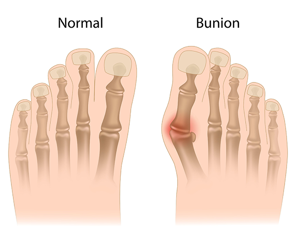 Bunions Treatment in Howard Beach