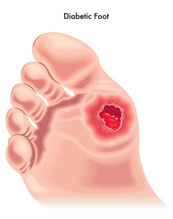 Diabetic Foot in Howard Beach