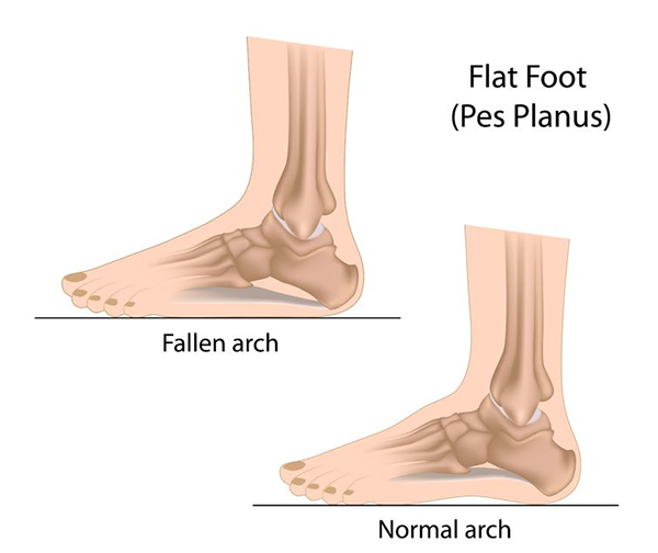 Flat Feet in Howard Beach