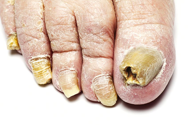 Fungal Nails in Howard Beach